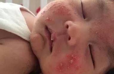 五个月宝宝脸上长粉刺怎么办