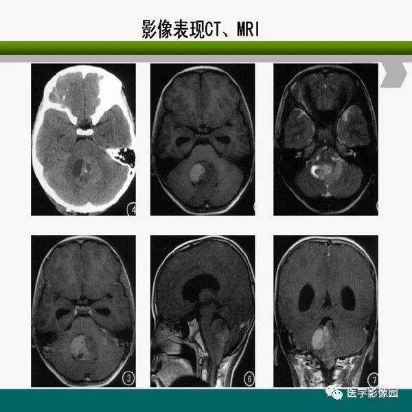 脑室内室管膜瘤的影像诊断及鉴别丨影像天地