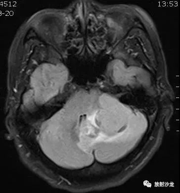 《神经病例:桥小脑角区实性占位病变》