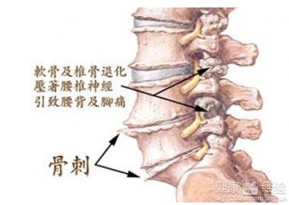 椎间盘,韧带等软组织变性,退化,关节边缘形成骨刺,滑膜肥厚等变化,而