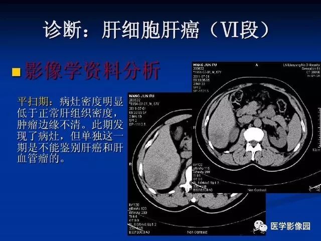 原发性肝癌的ct技术和诊断指南丨影像天地