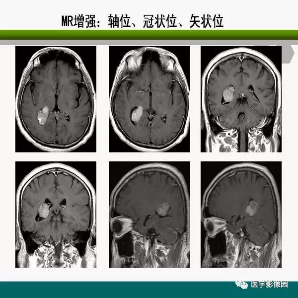 脑室内室管膜瘤的影像诊断及鉴别丨影像天地