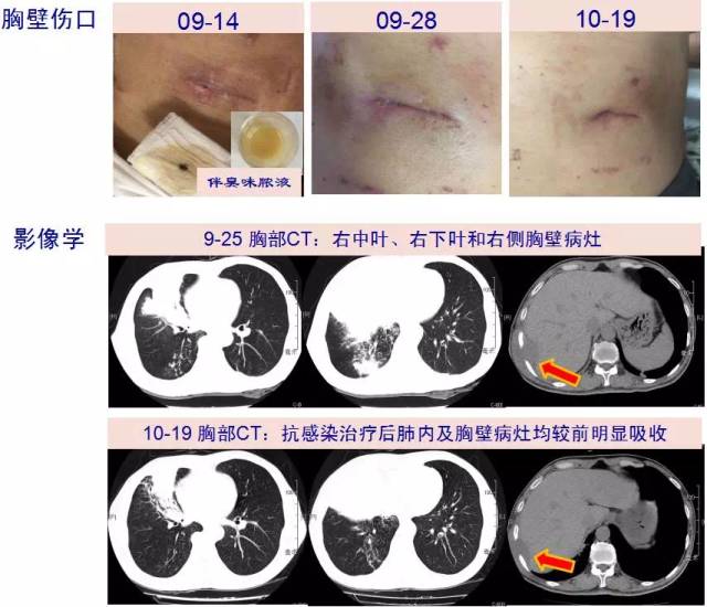 咳嗽痰血胸壁肿癌症脓肿迷魂宫ngs感染病例探讨