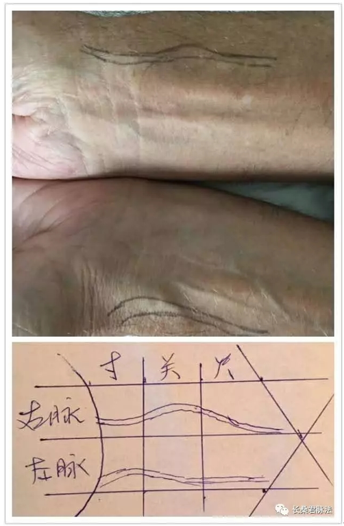 人迎三盛阳明燥,血痰多瘀心悸晓,病历1长桑君脉法传人—李树森老师