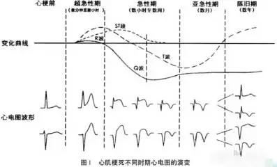 心电图之心肌梗死