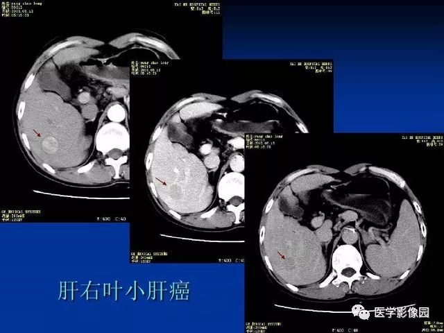 原发性肝癌的ct技术和诊断指南丨影像天地