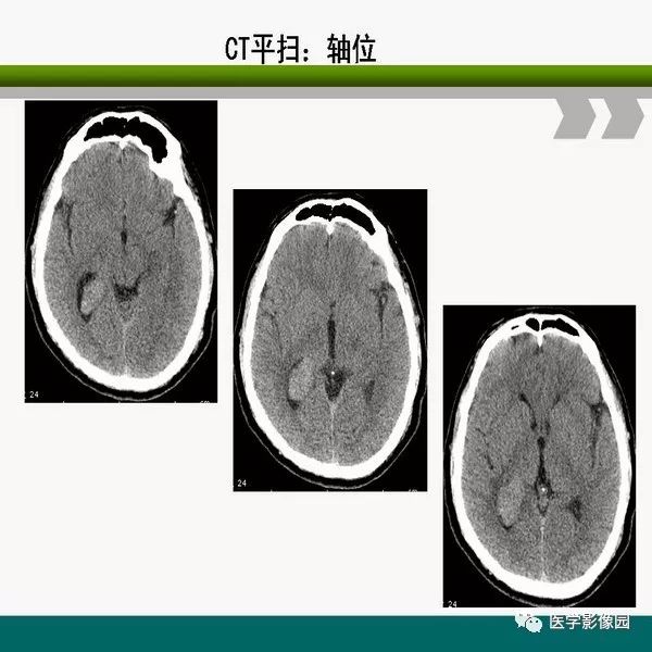 脑室内室管膜瘤的影像诊断及鉴别丨影像天地