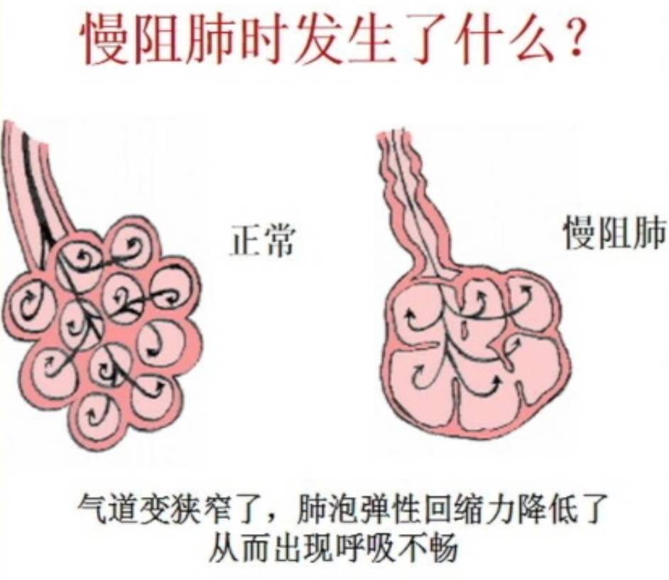 顾名思义,慢阻肺就是肺部慢慢感受到被阻塞.来给大家讲解一下.