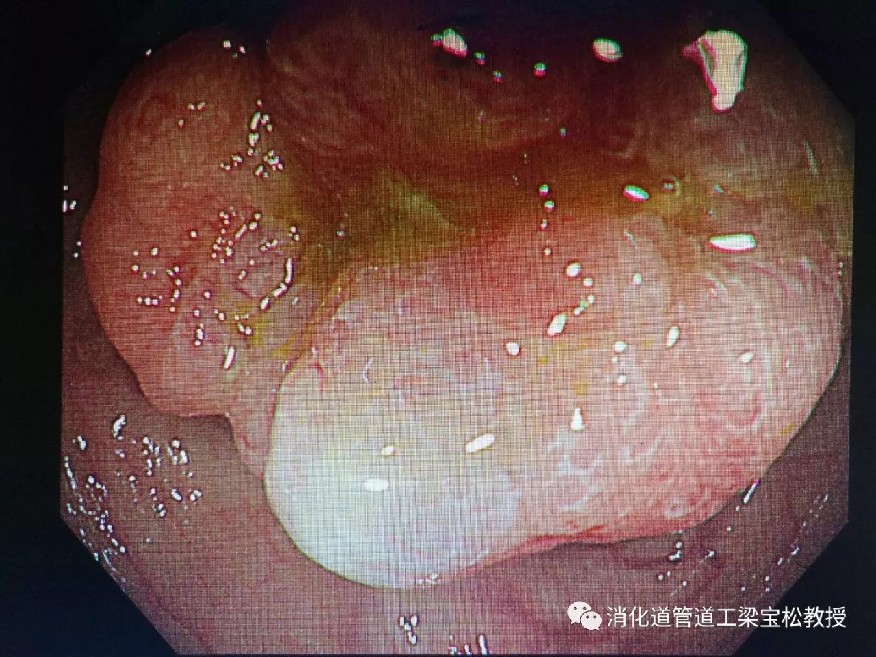 横结肠病变