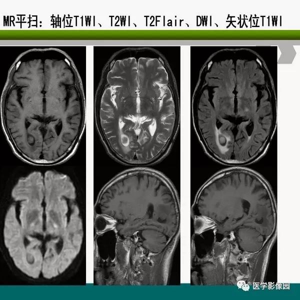 脑室内室管膜瘤的影像诊断及鉴别丨影像天地