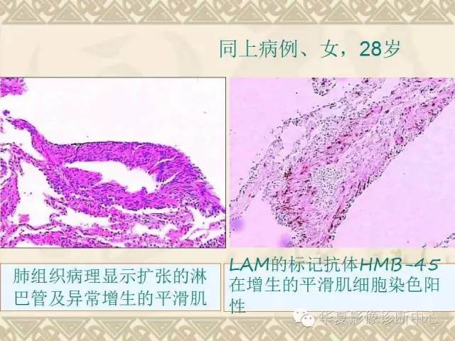 肺淋巴管肌瘤病,您还在误诊为肺气肿吗?