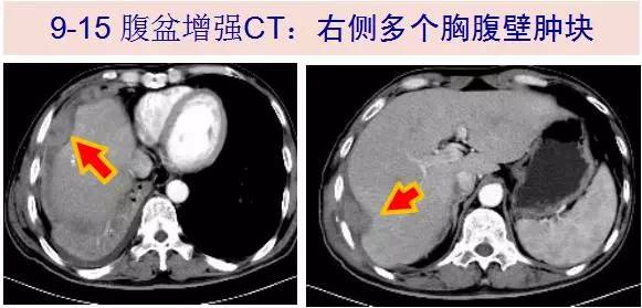 咳嗽痰血胸壁肿癌症脓肿迷魂宫ngs感染病例探讨