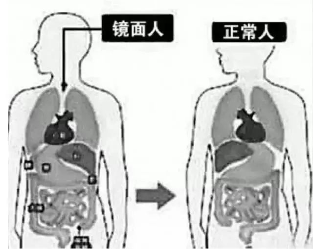 三明一女子心脏长在右边?主刀医生:从医30余年首次遇到