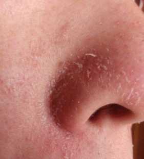 鼻子两侧有红血丝还起干皮怎么办是脂溢性皮炎吗