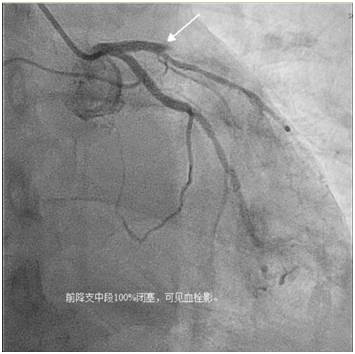 患者心电图和冠状动脉造影结果
