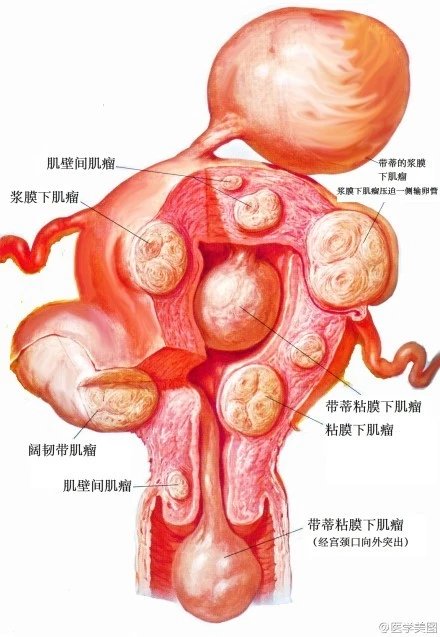 45,子宫肌瘤