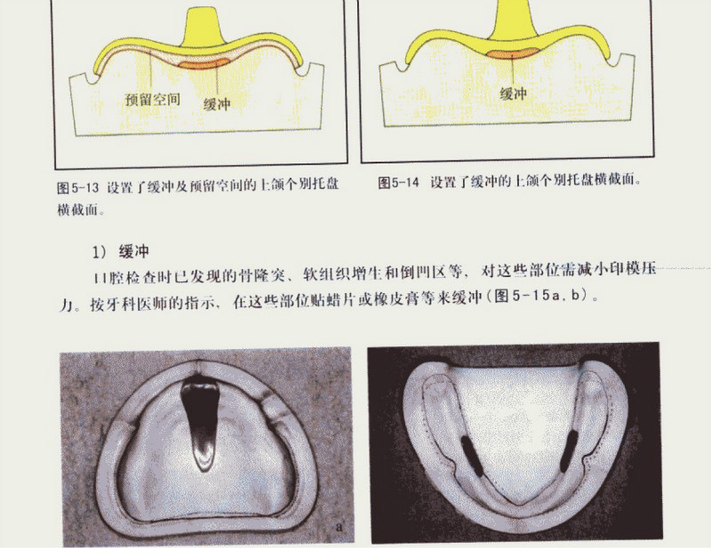 牙槽的四种分类