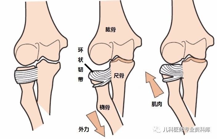 旋前位置时,如果受到外力的牵拉,那么容易把桡骨头从环状韧带里面拉