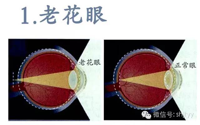 6种中老年人常见眼病,您中招了吗