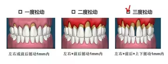 把牙齿的松动程度划分为一度,二度,三度 三度松动的牙齿,牙槽骨萎缩