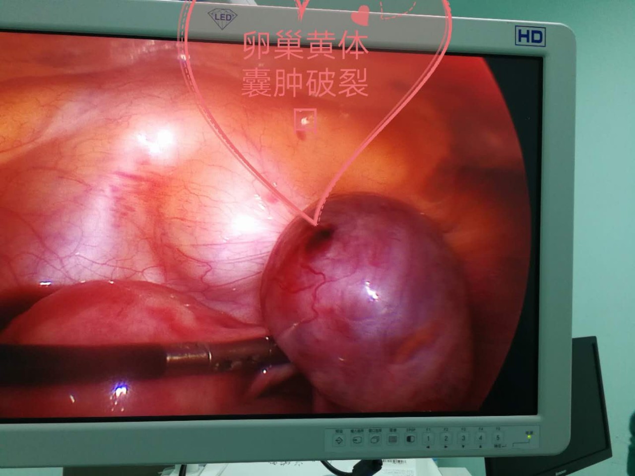 【临床一线】"小孔"解决黄体囊肿破裂大问题