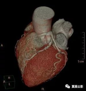 【影像病例】先天性冠状动脉畸形