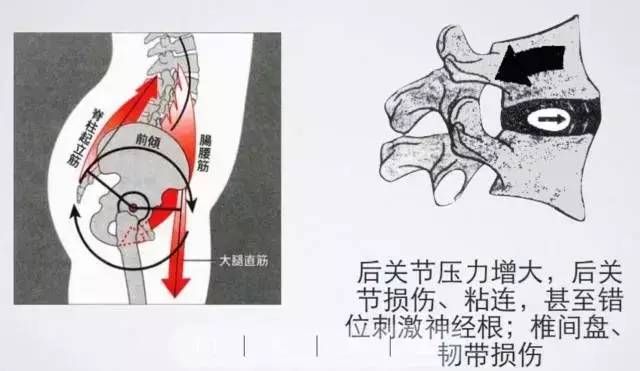 专家倾心解答燕飞动作不是所有腰椎间盘突出患者都能做