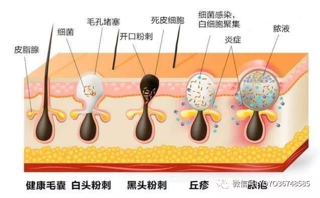 通常情况下,白头粉刺的管腔比较大,呈现不规则形状