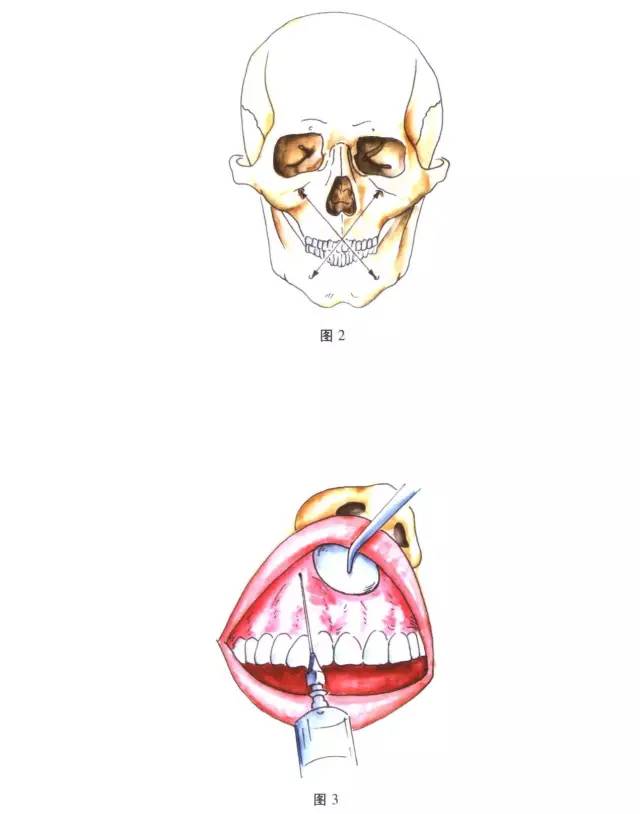 口腔颌面外科常用的十三种麻醉方法(全图谱)