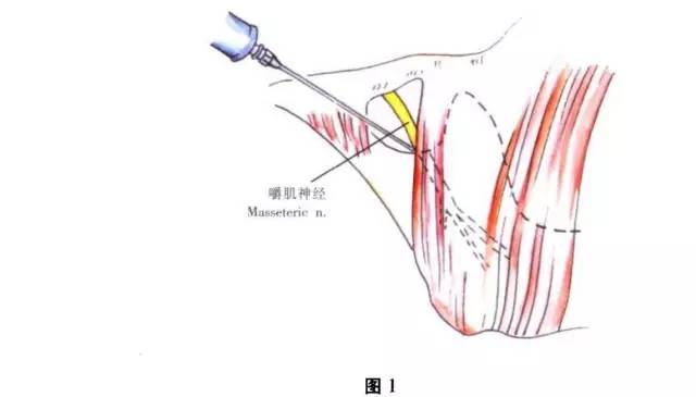 (1)口内法 1.进针点:在下颌第二双尖牙根尖颊沟移行皱襞处. 2.