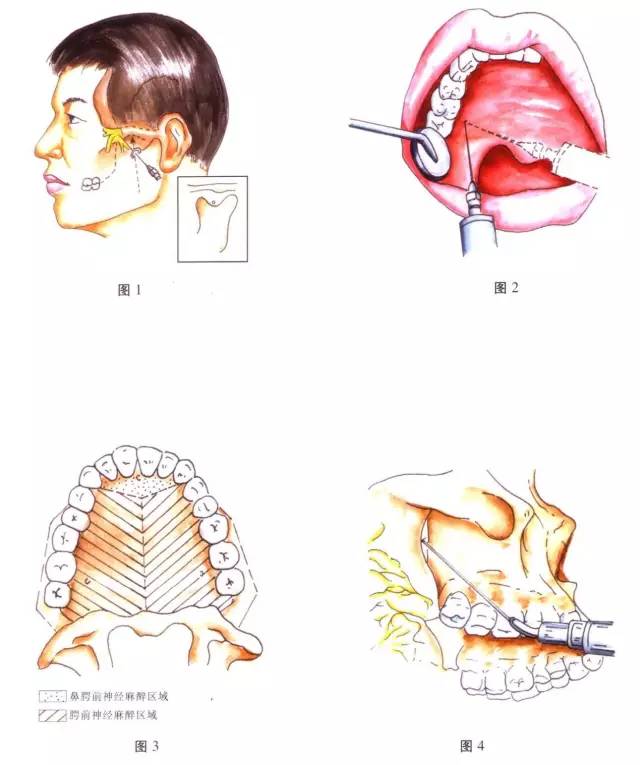 进针点:用25号细长针头,自对侧口角处向患侧腭大孔投影的标志黏膜凹陷