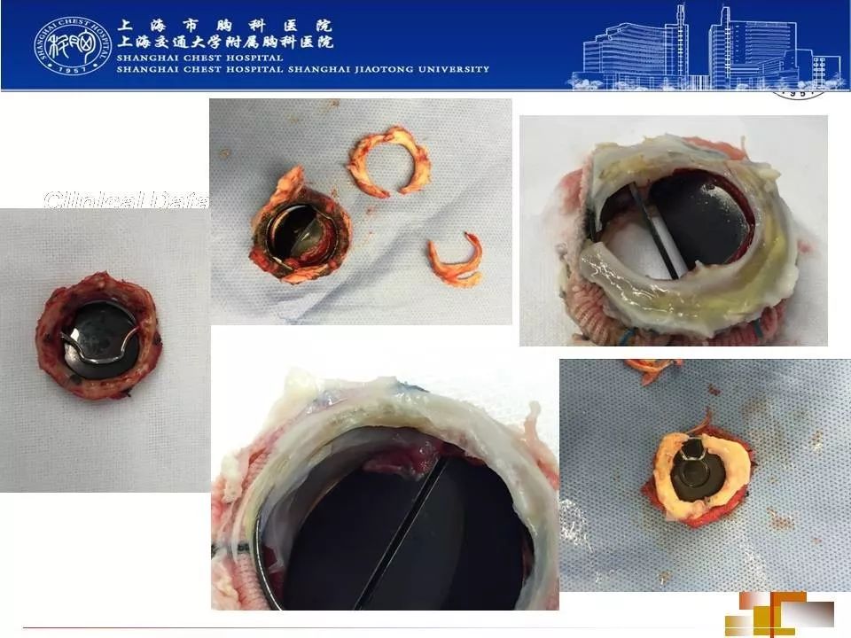 开展各类冠心搭桥术,心脏单,双瓣膜置换术及瓣膜成形术及各种心脏复杂