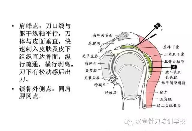 针刀治疗三角肌损伤及三角肌滑囊炎