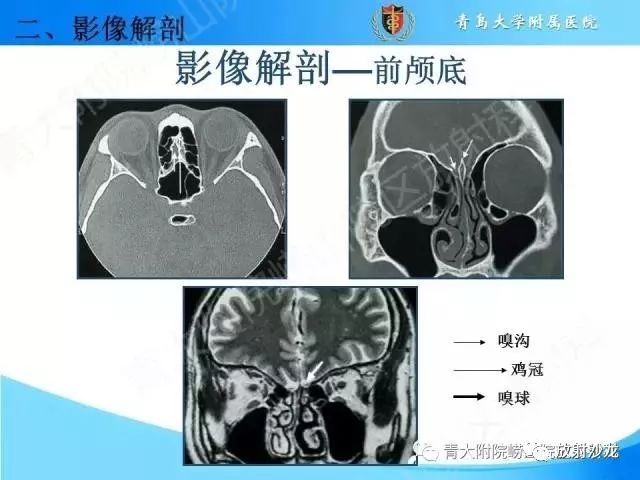 颅底孔道的影像解剖和诊断