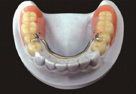 其适用范围从用于牙间隙修复,到单侧和双侧游离缺失修复,至余留单颗牙