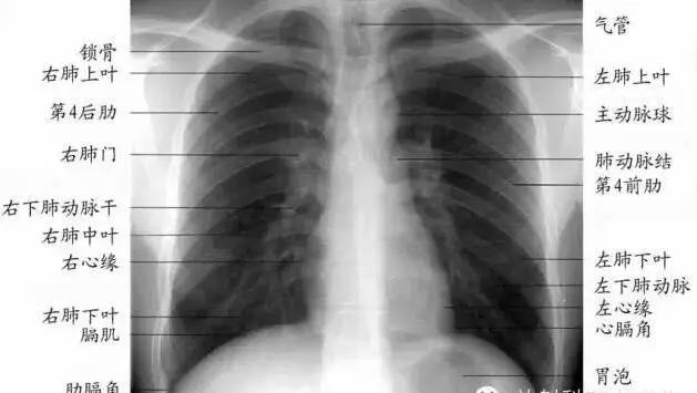 反复上呼吸道感染者,季节性哮喘发作者,老慢支患者定期复查,x胸片异常