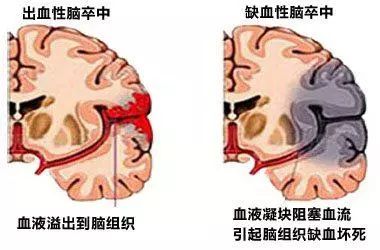 脑组织就会出现缺血坏死,也就是人们常说的"脑梗死"或"缺血性脑卒中"