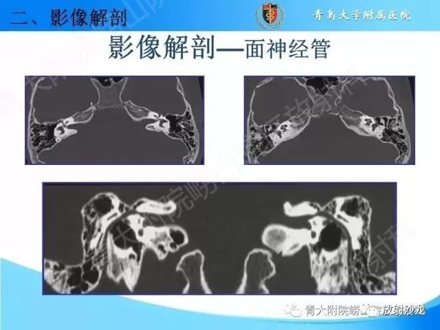 颅底孔道的影像解剖和诊断