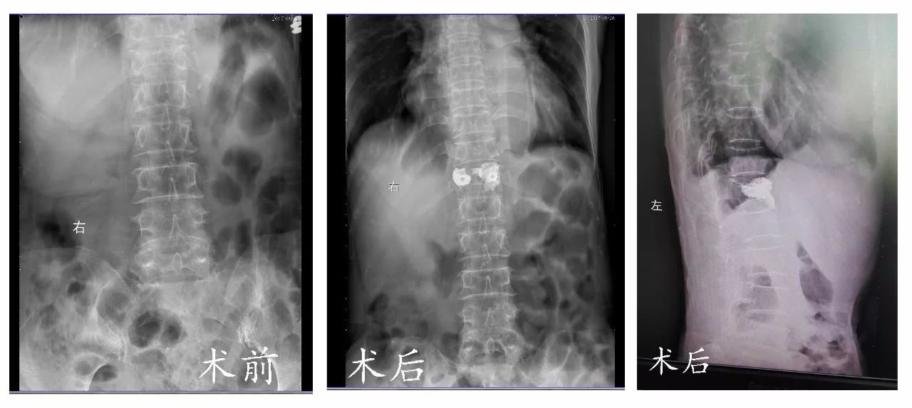 新华骨科成熟开展胸、腰椎体压缩性骨折经皮穿刺球囊扩张后凸椎体成形术 