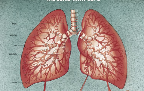肺纤维化治疗—肺纤维化是怎么形成的