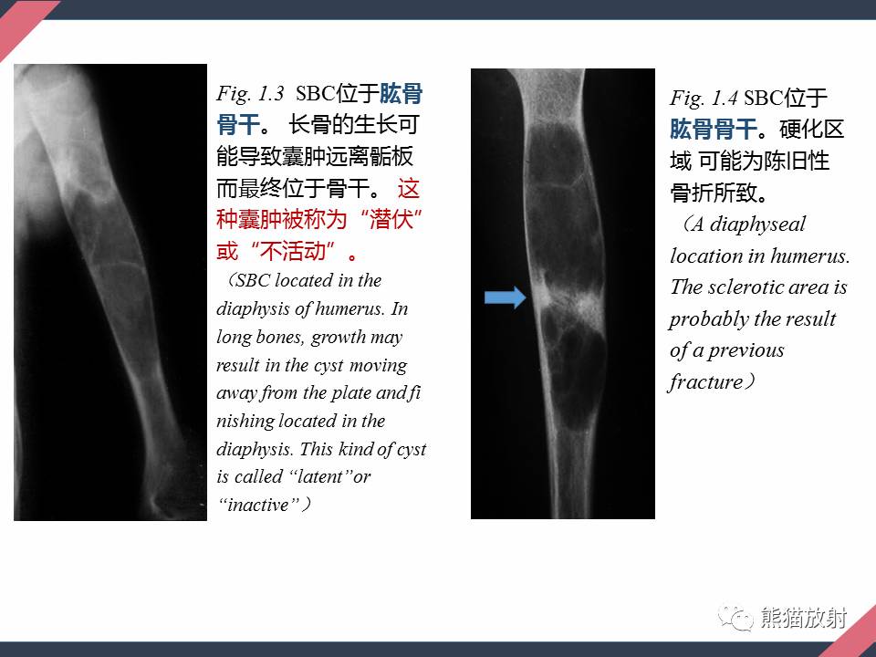 【专题】骨肿瘤样病变(1):骨囊肿(从病理到影像)