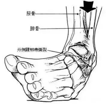 健康科普崴脚不当回事做错小心遗憾终生附踝关节康复训练图