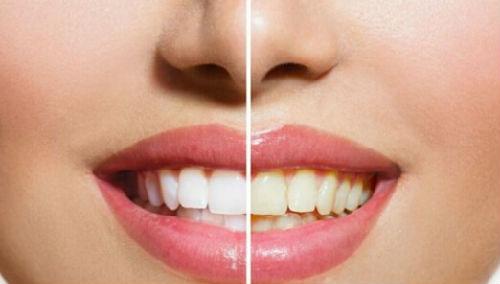正常的牙齿是稍微偏黄的,日常所看到的电视广告上的超洁白牙齿通常是