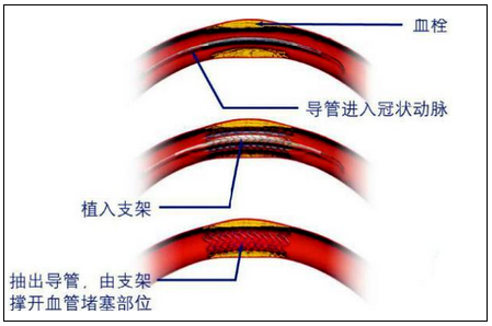 经皮冠状动脉介入治疗示意图(网络图)