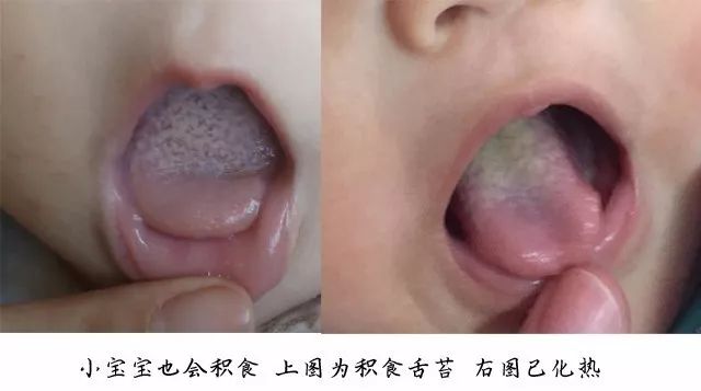 慢性积食怎么办