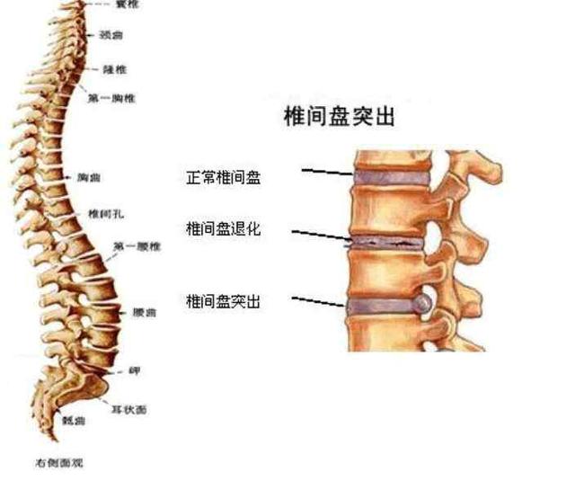 症患者最先出现的症状,但并非所有腰椎间盘突出的患者都会出现腰痛