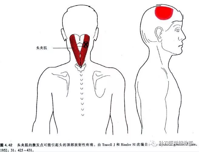 局部解剖头夹肌易在第七颈椎处劳损,在止点枕骨上项线处也极 易损伤.