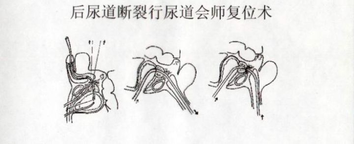 诏安同济医院外科成功完成首例输尿管镜下尿道会师术