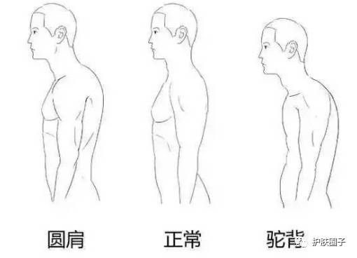 背厚驼背怎么搭_驼背图片儿童