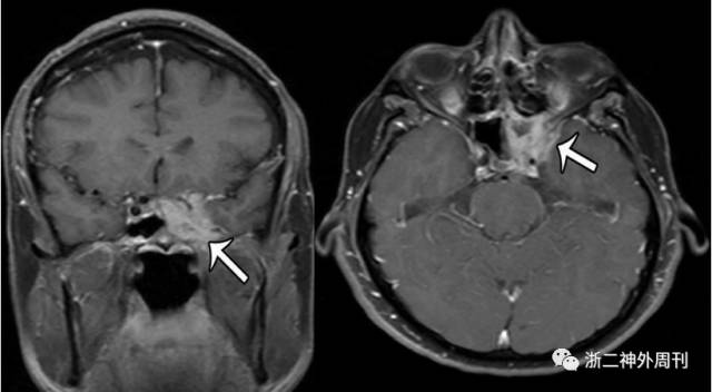 儿童眶尖海绵窦颞下窝病变一例浙二神外周刊第116期